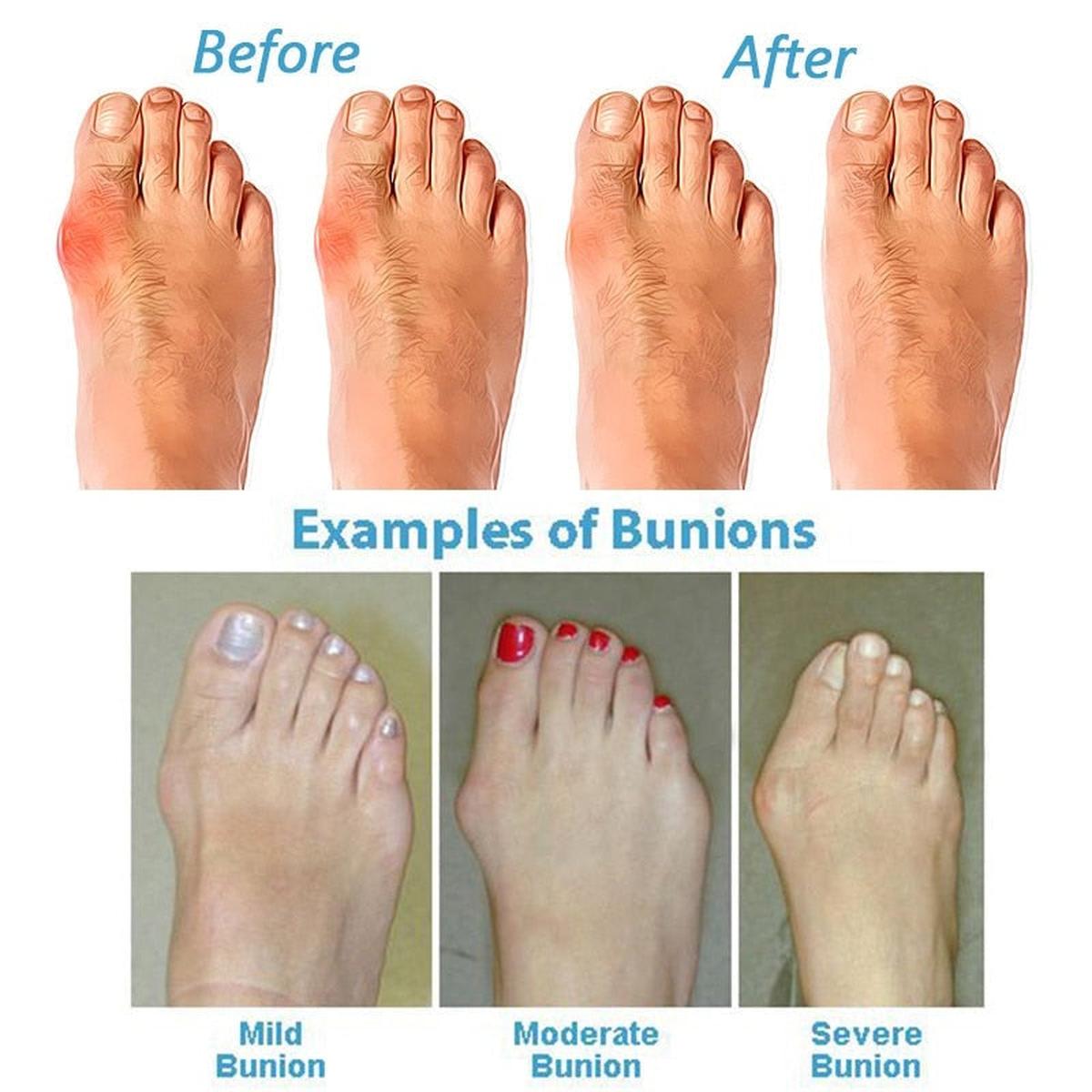 Orthopedic Sandals For Bunions And Posture Correction